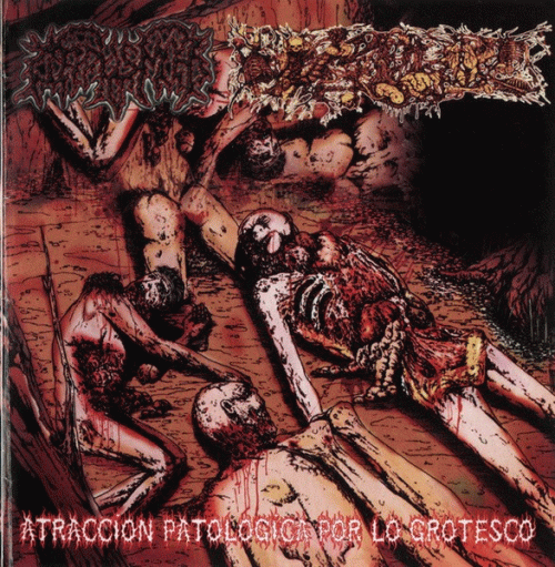 Paracoccidioidomicosisproctitissarcomucosis : Atraccion Patologica por lo Grotesco